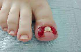 Imagen numero 3 del servicio ONICOCRIPTOSIS O UÑAS INCARNADAS