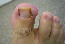 Imagen numero 2 del servicio ONICOCRIPTOSIS O UÑAS INCARNADAS