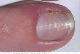 Imagen numero 1 del servicio ONICOCRIPTOSIS O UÑAS INCARNADAS