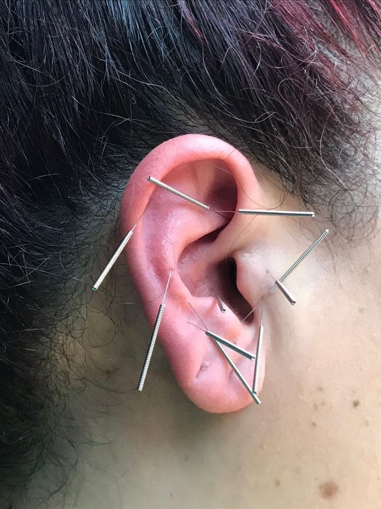 Imagen numero 1 del servicio Auriculopuntura