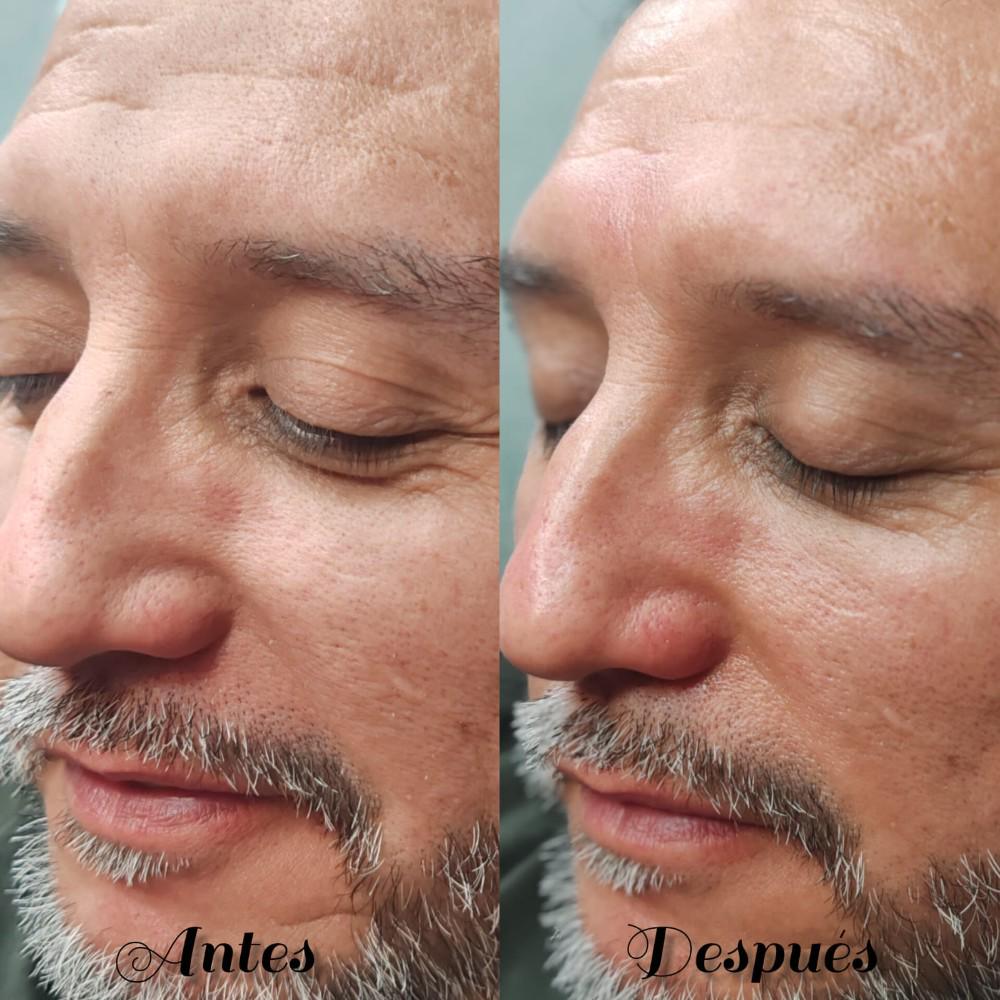 Imagen numero 1 del servicio Limpieza facial profunda