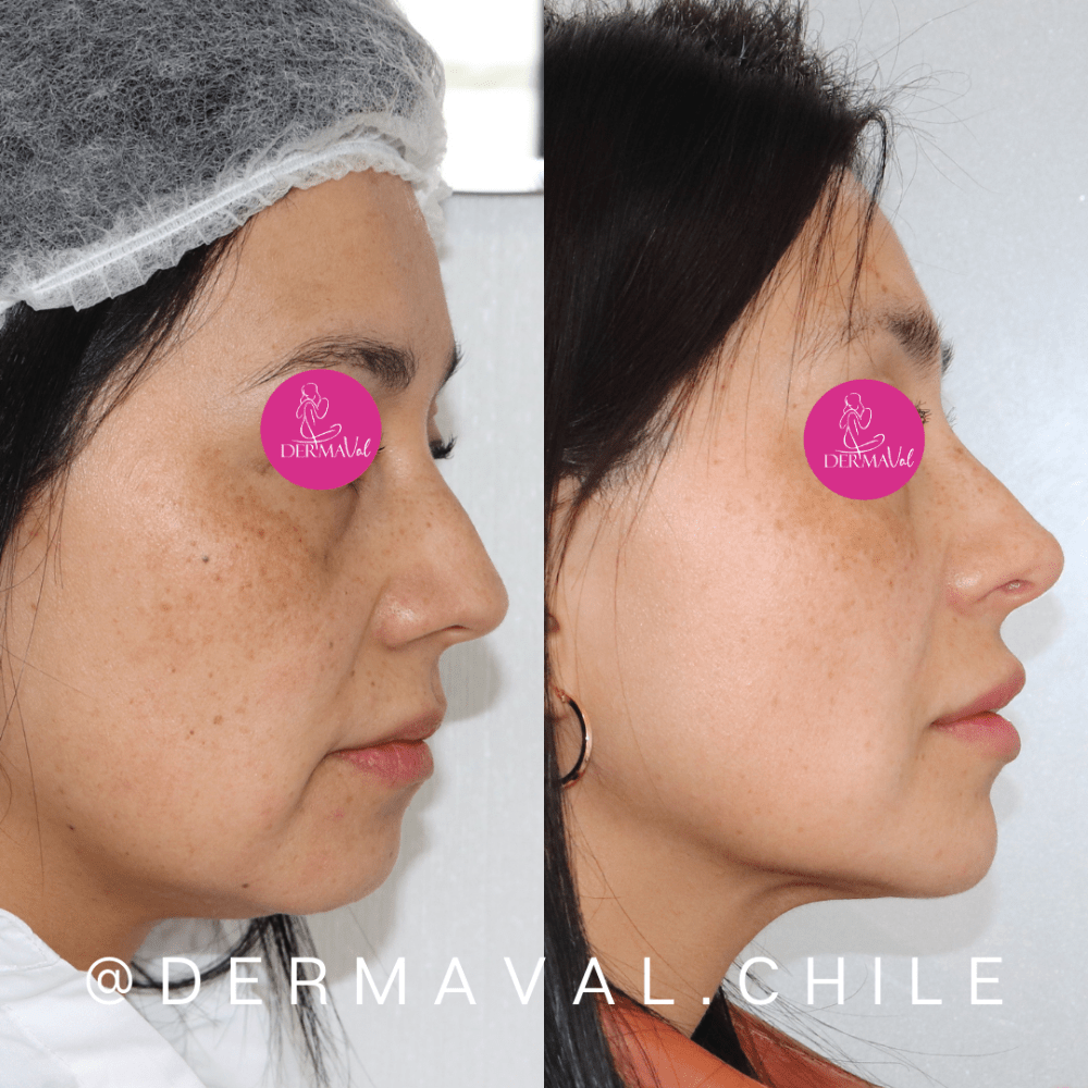 Imagen numero 2 del servicio Armonización facial con ácido hialurónico
