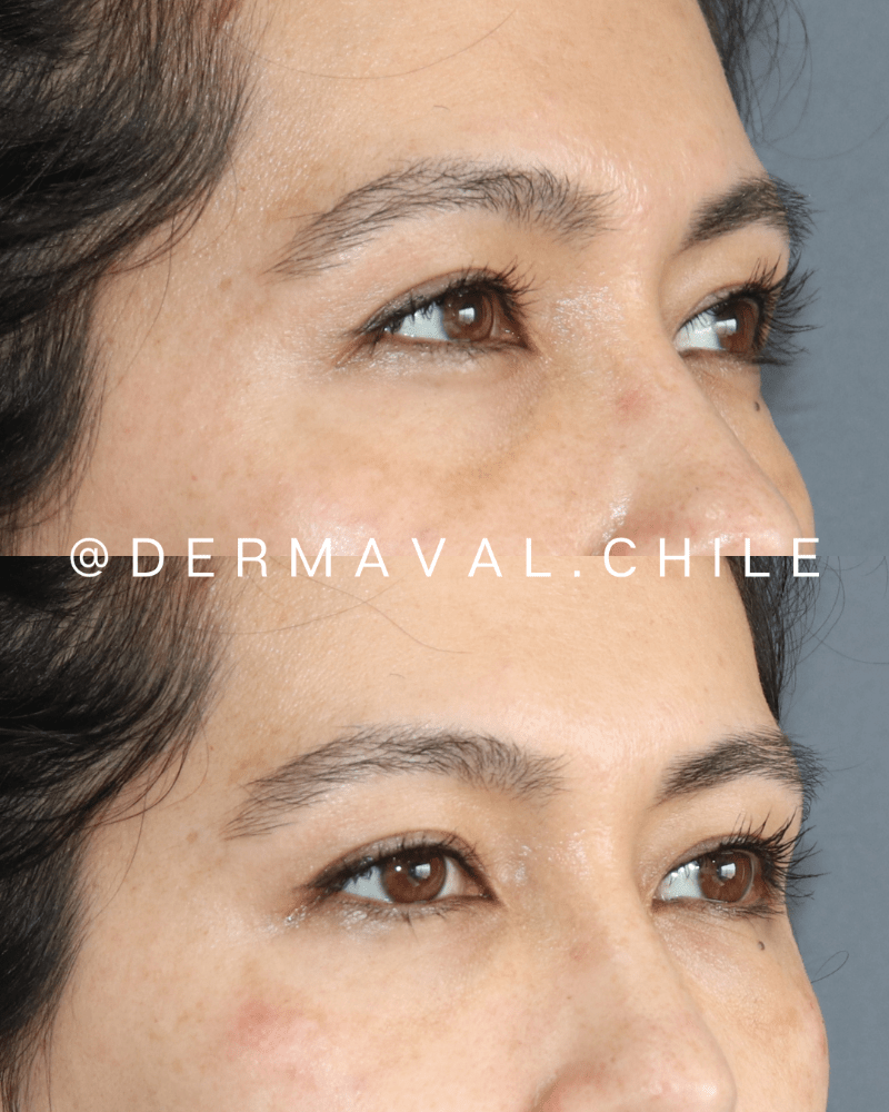 Imagen numero 1 del servicio Inbiotec amber para cicatrices y ojeras