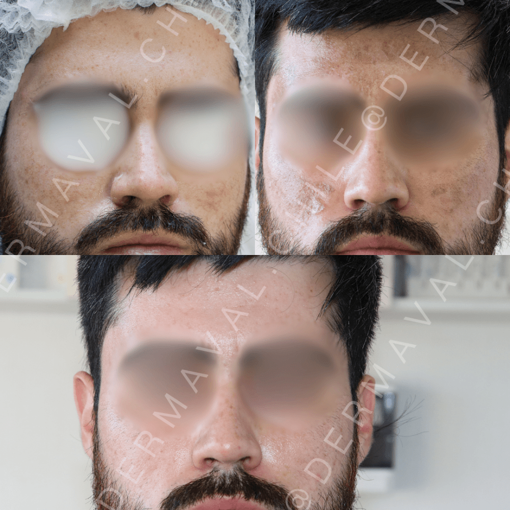 Imagen numero 1 del servicio Peeling químico medio