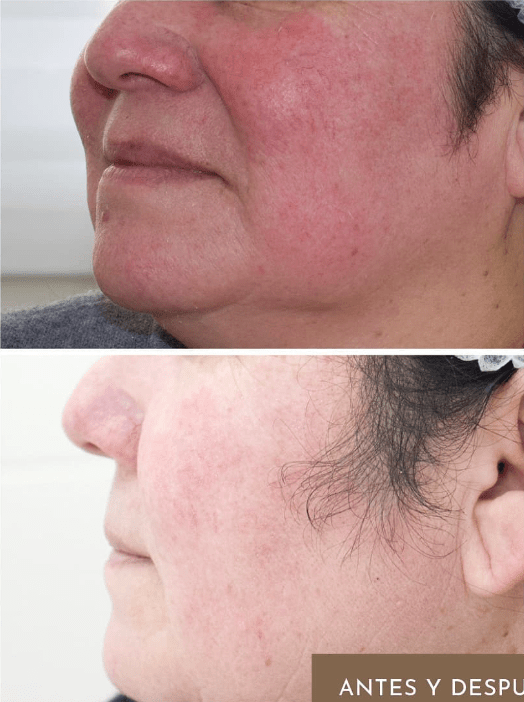 Imagen numero 2 del servicio Microneedling facial con cóctel de vitaminas