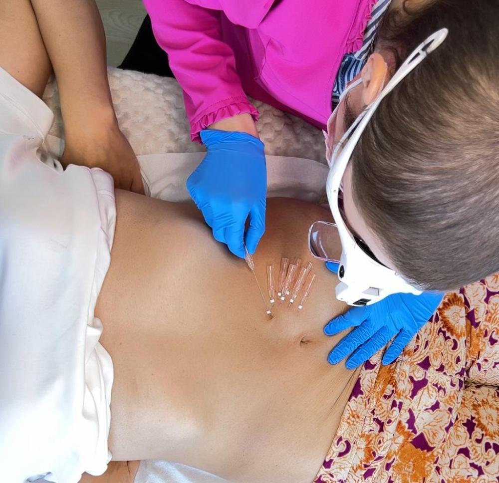 Imagen numero 1 del servicio Hilos bioestimuladores