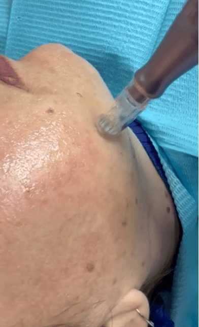 Imagen numero 1 del servicio Microneedling facial con cóctel de vitaminas