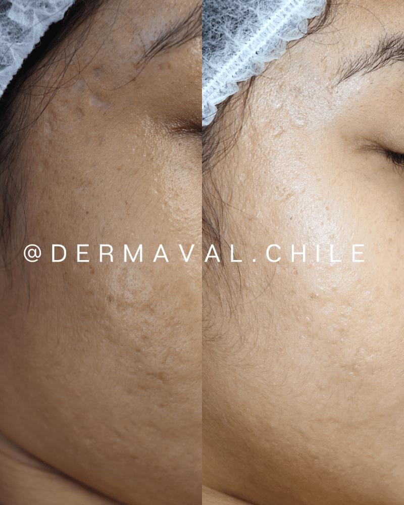 Imagen numero 2 del servicio Inbiotec amber para cicatrices y ojeras
