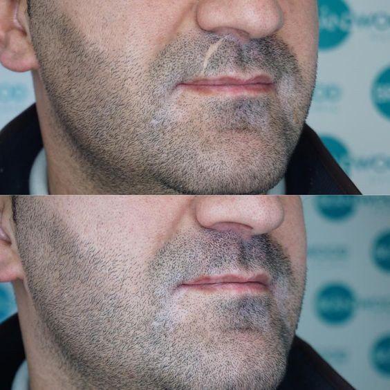 Imagen numero 2 del servicio Micropigmentación de barba