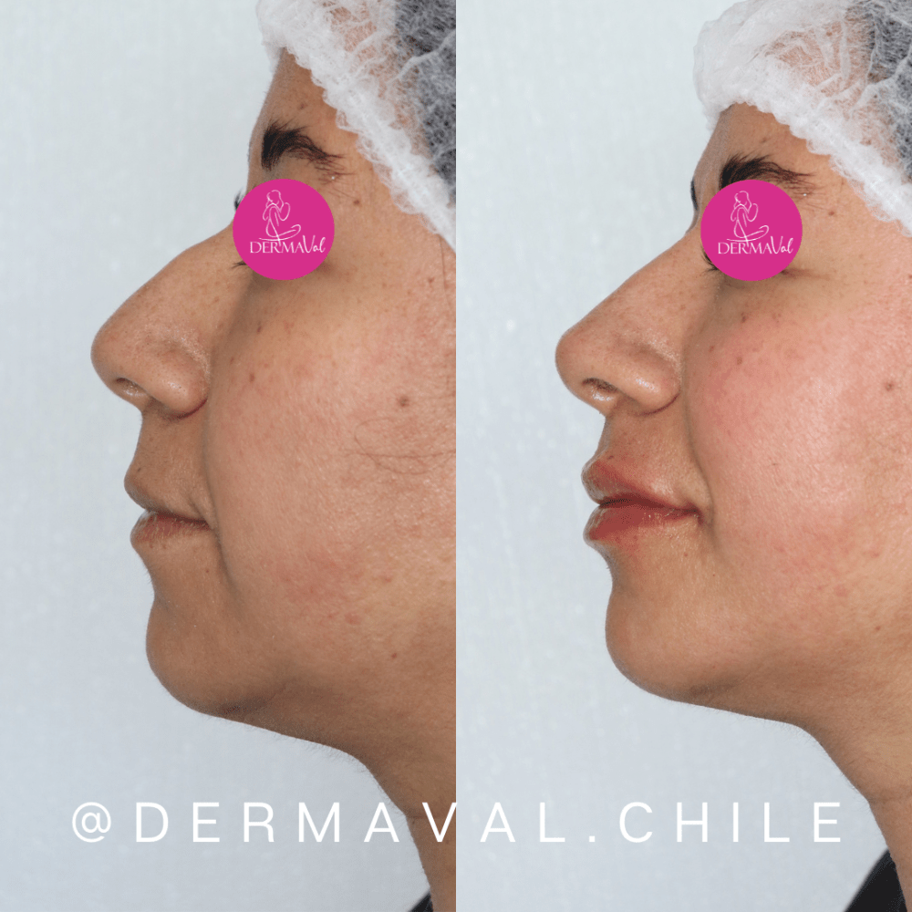 Imagen numero 1 del servicio Armonización facial con ácido hialurónico