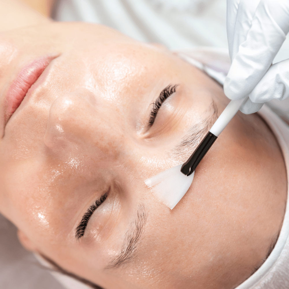 Imagen numero 1 del servicio Peeling químico superficial