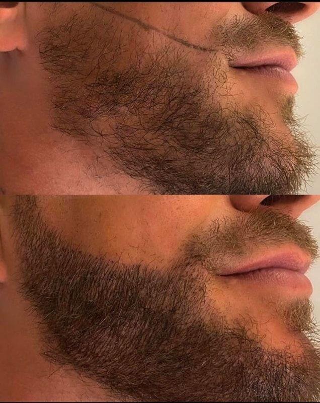 Imagen numero 1 del servicio Micropigmentación de barba