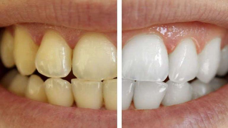 Imagen numero 1 del servicio Clareamiento dental (Blanqueamiento) Por pieza