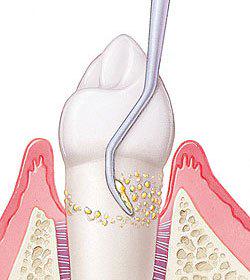 Imagen numero 1 del servicio Tratamiento Periodontal - Pulido Radicular