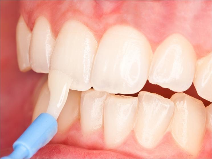 Imagen numero 1 del servicio Fluoración dental / Aplicación Flúor Barniz + Profilaxis