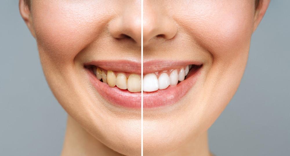 Imagen numero 1 del servicio Clareamiento dental (Blanqueamiento)