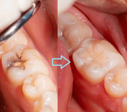 Imagen numero 1 del servicio Restauración de Composite (tapaduras) / Reconstrucción
