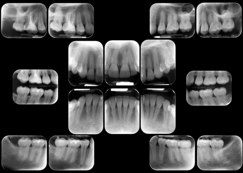 Imagen numero 1 del servicio Radiografía Retroalveolar Total o Periapical Total
