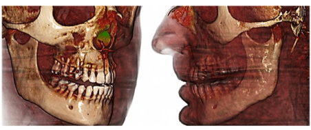 Imagen numero 2 del servicio Exámenes 3D (ATM Boca abierta y cerrada, dos tomas)