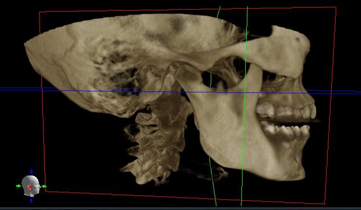 Imagen numero 1 del servicio Exámenes 3D (ATM Boca abierta y cerrada, dos tomas)