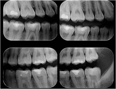 Imagen numero 1 del servicio Radiografía Bite Wing o Aleta Mordida