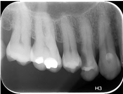 Imagen numero 1 del servicio Radiografía Retroalveolar o Periapical