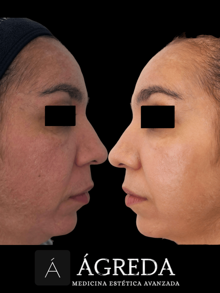 Imagen numero 1 del servicio Vitaminas c/ dermapen 3 sesiones