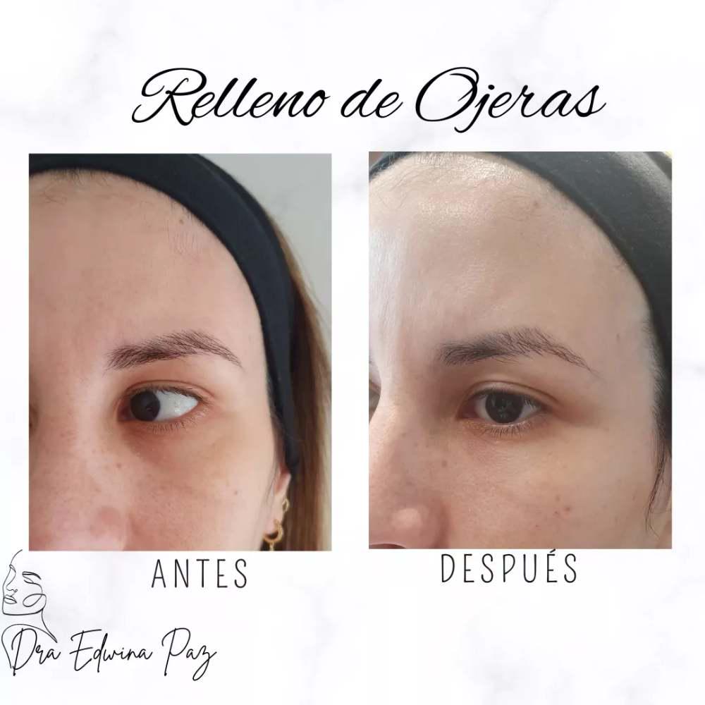 Imagen numero 2 del servicio Ojeras