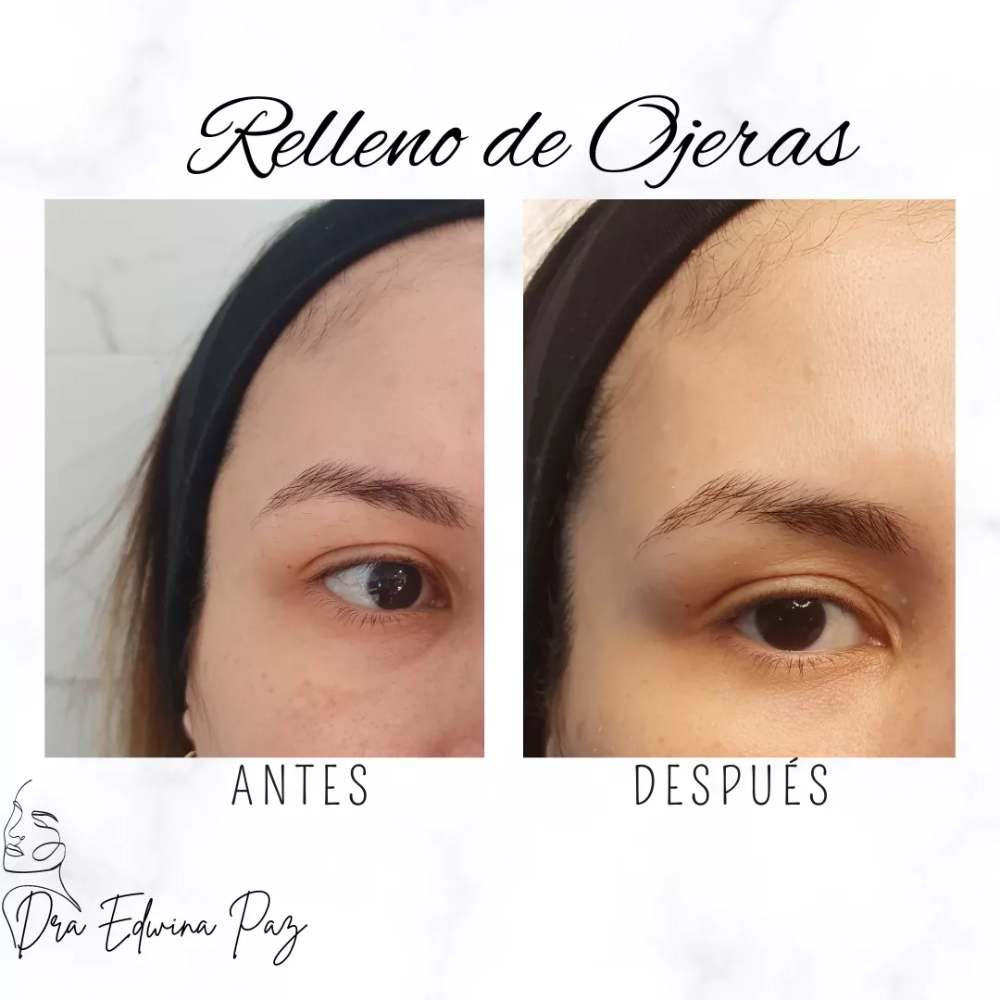 Imagen numero 3 del servicio Ojeras
