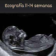 Imagen numero 1 del servicio Ecografía 11-14 semanas + Doppler
