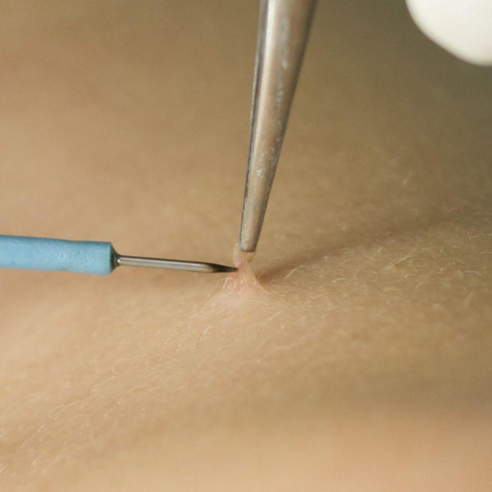 Imagen numero 1 del servicio Extracción Condilomas, Molusco contagioso, entre otros