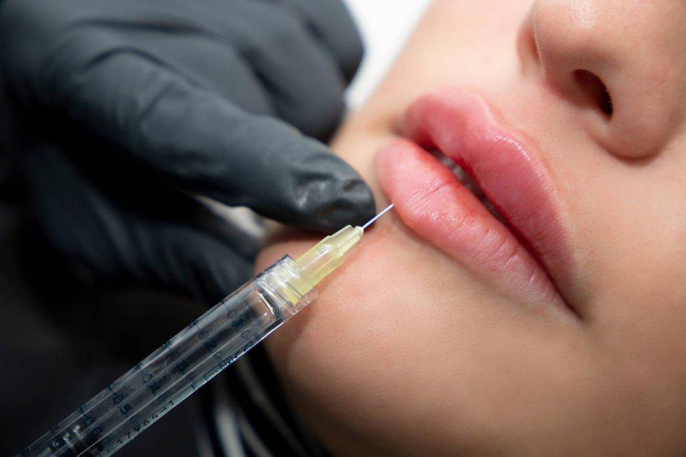 Imagen numero 1 del servicio Aumento de labios con Ácido Hialuronico