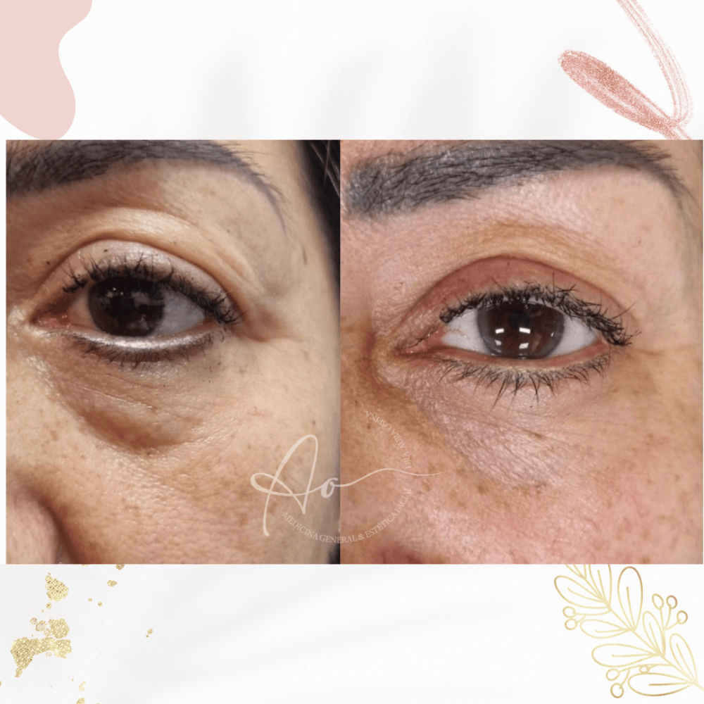 Imagen numero 1 del servicio Relleno de ojeras con Ácido Hialuronico
