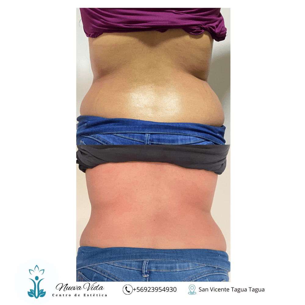 Imagen numero 1 del servicio Tratamiento Reductivo Abdomen