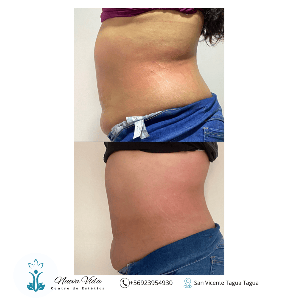 Imagen numero 3 del servicio Tratamiento Reductivo Abdomen