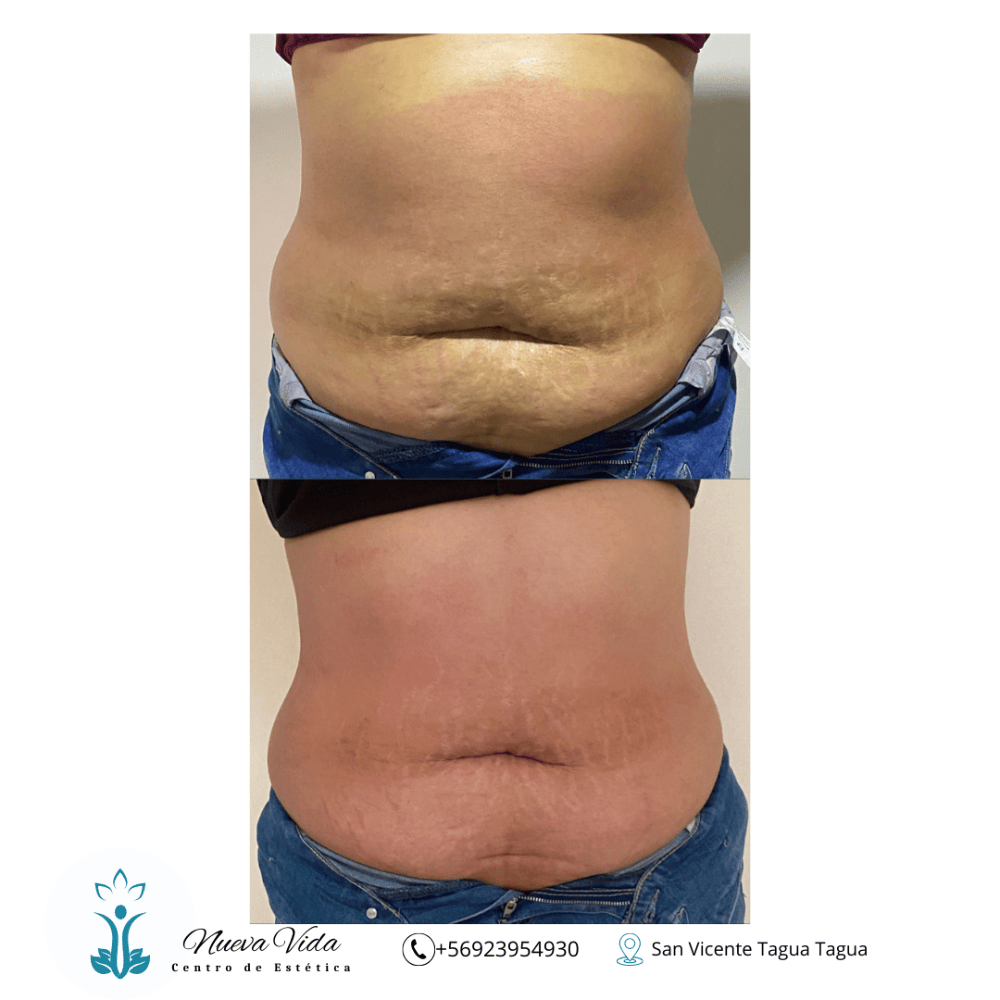 Imagen numero 2 del servicio Tratamiento Reductivo Abdomen