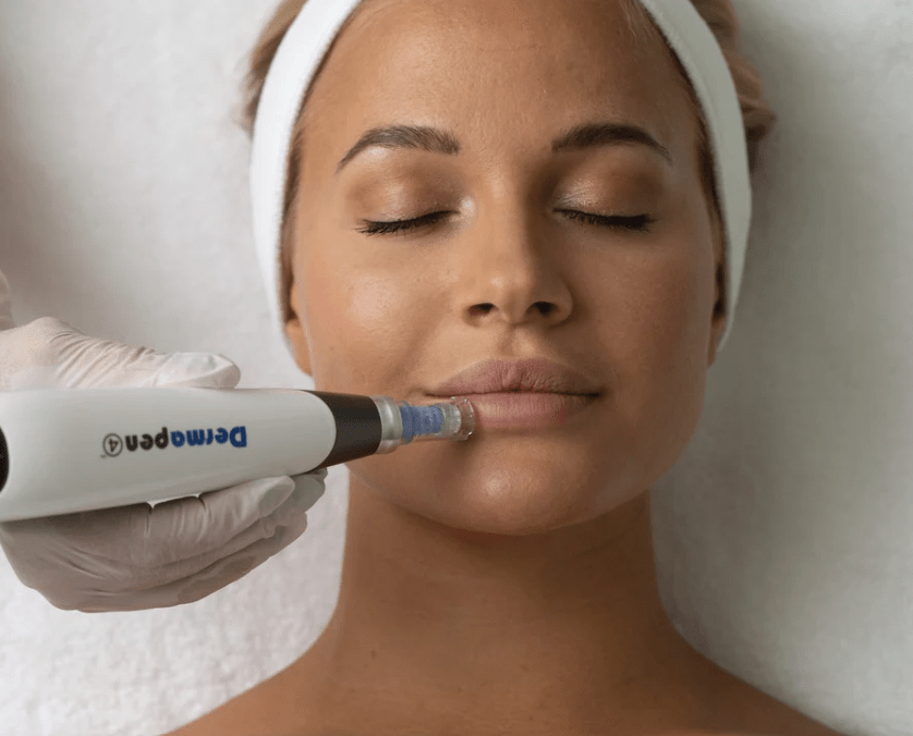 Imagen numero 1 del servicio Vitaminas con Dermapen