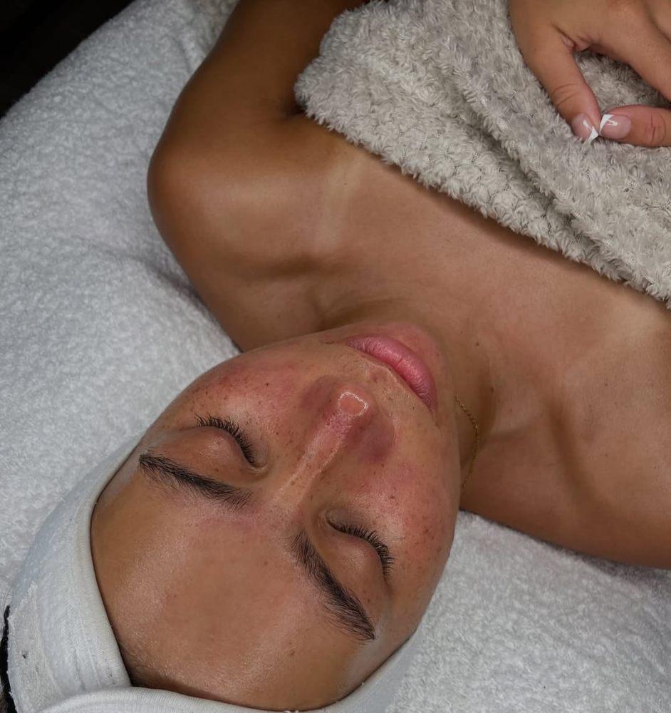 Imagen numero 2 del servicio Rejuvenecimiento Facial 馃崐