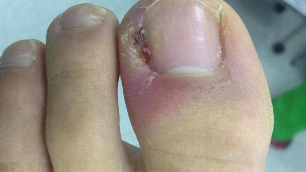 Imagen numero 1 del servicio Servicio de Onicocriptosis (uñas encarnadas) Estudiantes