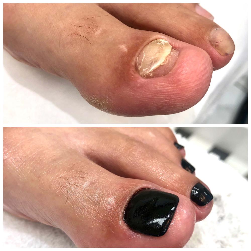 Imagen numero 1 del servicio Podología Estética con Reconstrucción Ungueal
