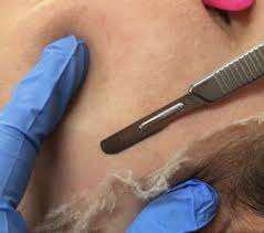 Imagen numero 2 del servicio Procedimiento Dermaplaning