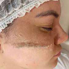 Imagen numero 3 del servicio Procedimiento Dermaplaning