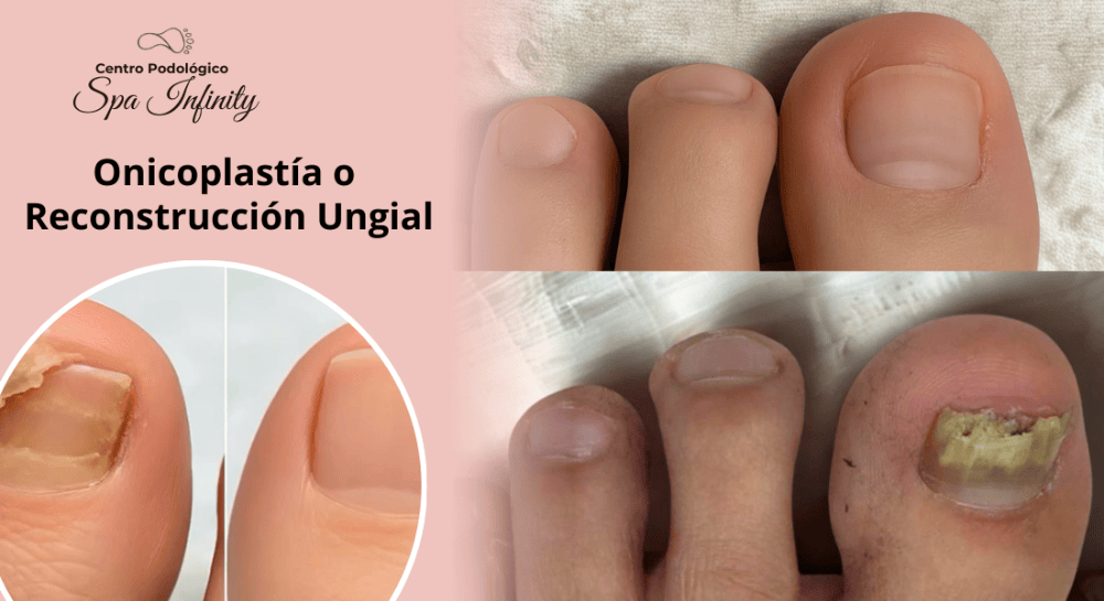 Imagen numero 1 del servicio Onicoplastia o Reconstrucción Ungueal