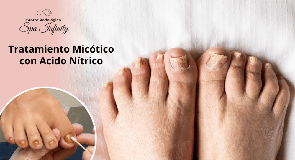 Imagen numero 1 del servicio Tratamiento Micótico con Ácido Nítrico