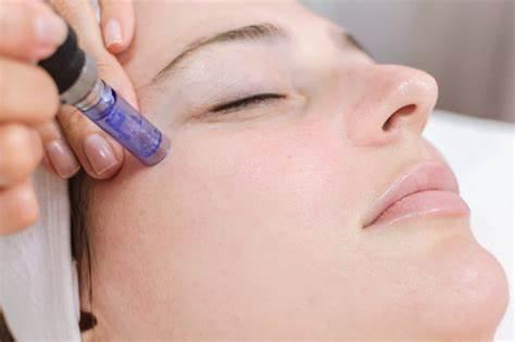 Imagen numero 1 del servicio dermapen