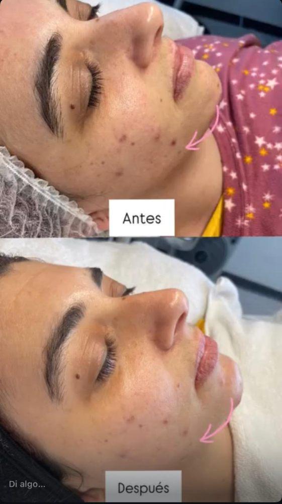 Imagen numero 3 del servicio Peeling químico Coreano Despigmentante