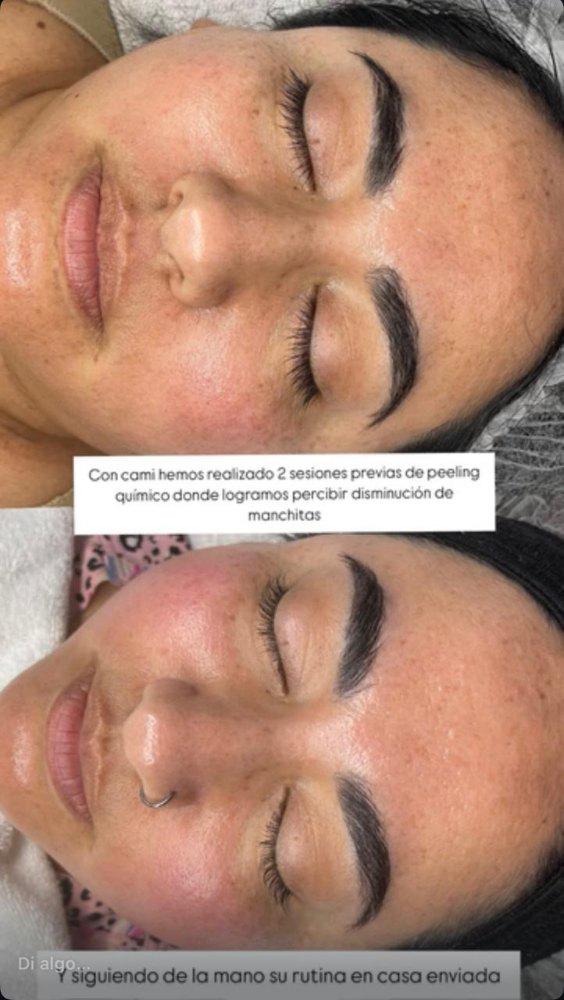 Imagen numero 1 del servicio Peeling químico Coreano Despigmentante