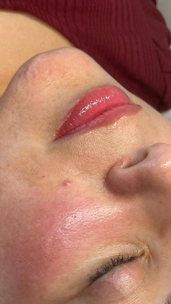 Imagen numero 3 del servicio Revitalización de labios con microagujas