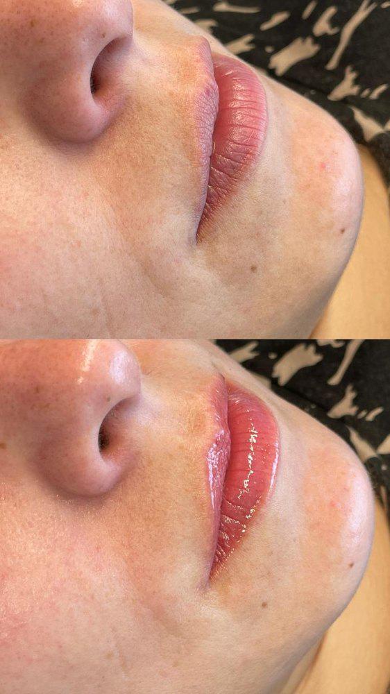 Imagen numero 2 del servicio Revitalización de labios con microagujas