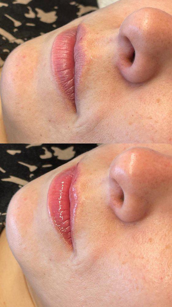 Imagen numero 1 del servicio Revitalización de labios con microagujas